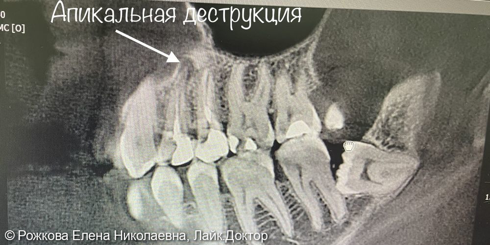 Лечение периодонтита фото 3 · Воронеж