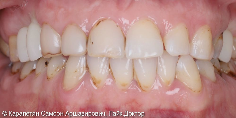 Реабилитация верхней челюсти фото 4 · Вологда