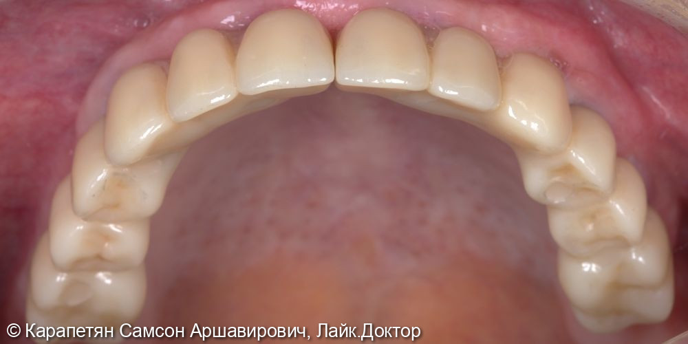 Реабилитация верхней челюсти фото 3 · Вологда