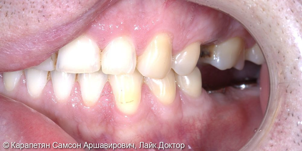 Реабилитация нижней челюсти фото 2 · Вологда