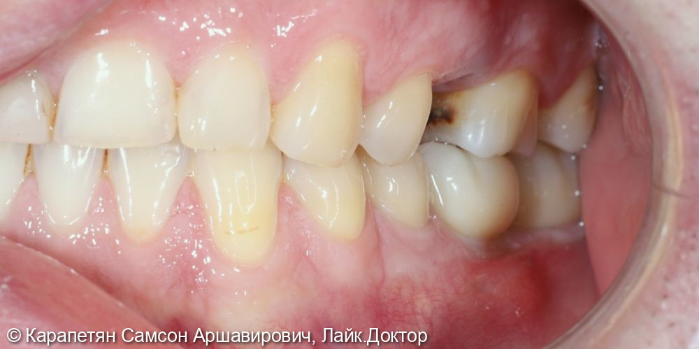 Реабилитация нижней челюсти фото 3 · Вологда