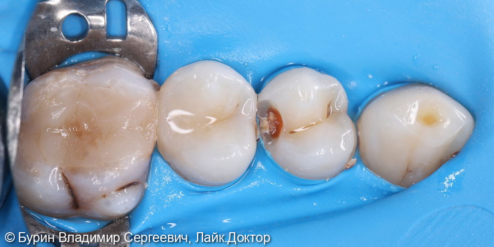 Лечение под микроскопом фото 2 · Вологда