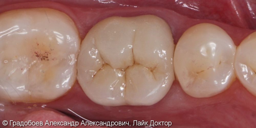 Изготовление коронки из диоксида циркония - фото №2