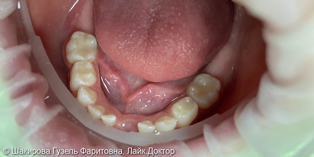 лечение кариеса молочных зубов 84,85 - фото №2