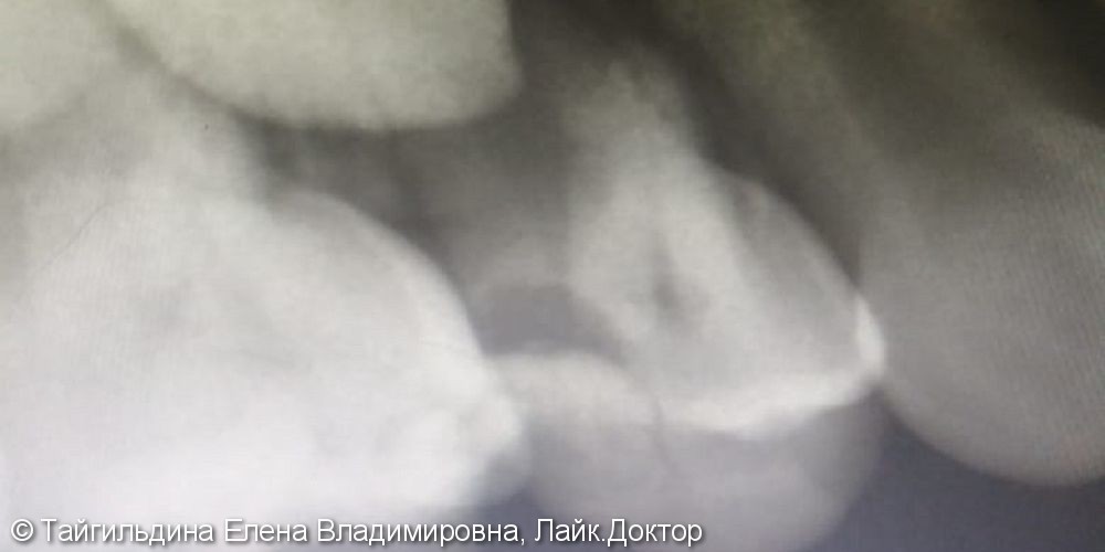 Удаление 54 зуба, обострение хронического периодонтита - фото №3