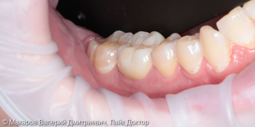 Восстановление зуба ZnO коронкой в полную анатомию - фото №1