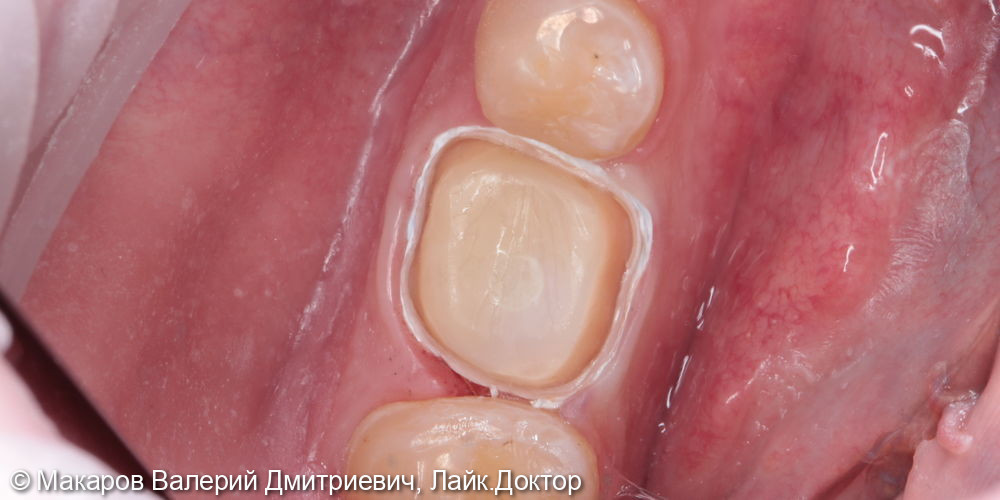 Восстановление зуба ZnO коронкой в полную анатомию - фото №2