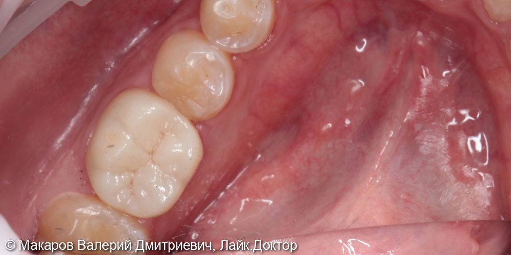 Восстановление зуба ZnO коронкой в полную анатомию - фото №3