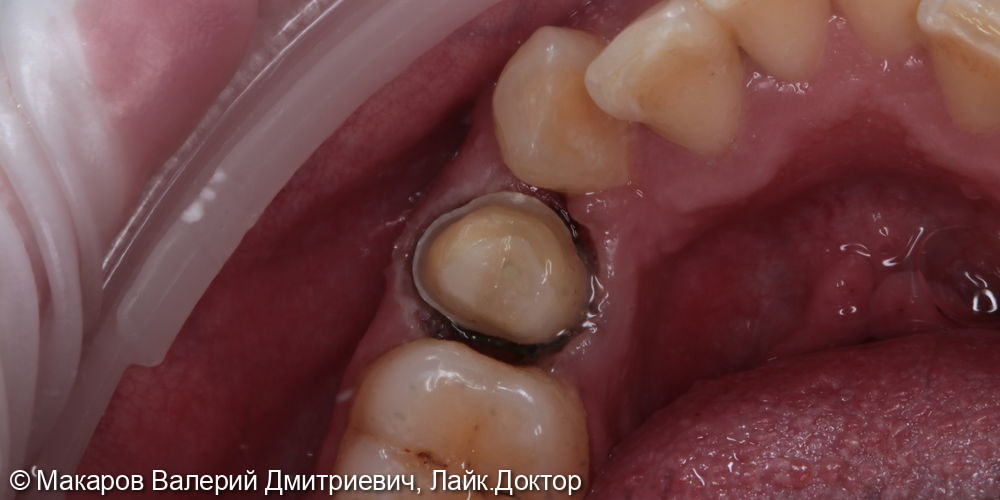 протезирование зуба 44 - фото №1