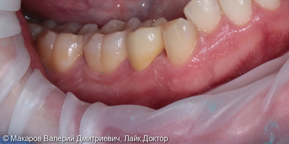 протезирование зуба 44 - фото №2