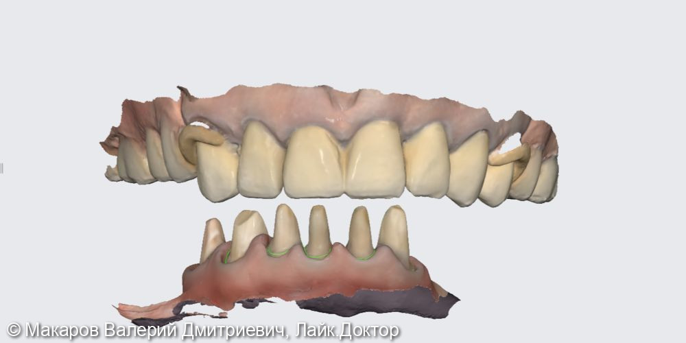 Протезирование зубов верхней и нижней челюсти - фото №1
