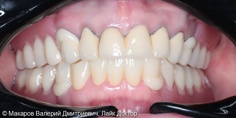 Протезирование зубов верхней и нижней челюсти - фото №2