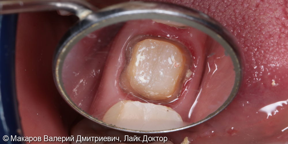 восстановление зуба 46 металлокерамической коронкой - фото №1