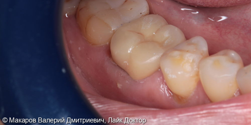 восстановление зуба 46 металлокерамической коронкой - фото №2