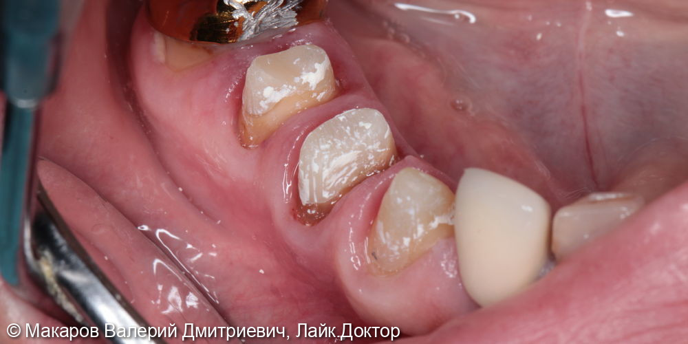 восстановление сильно разрушенных зубов 43,44,45 отдельными металлокерамическими коронками - фото №1