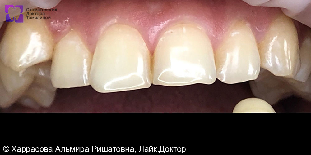Отбеливание по системе Amazing White фото 2 · Уфа