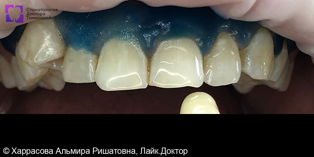 Отбеливание по системе Amazing White фото 3 · Уфа