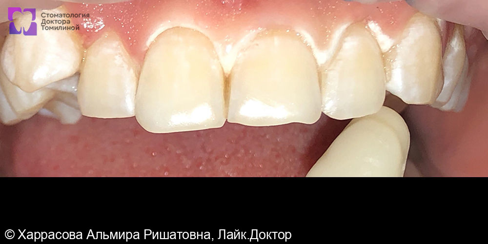 Отбеливание по системе Amazing White фото 4 · Уфа