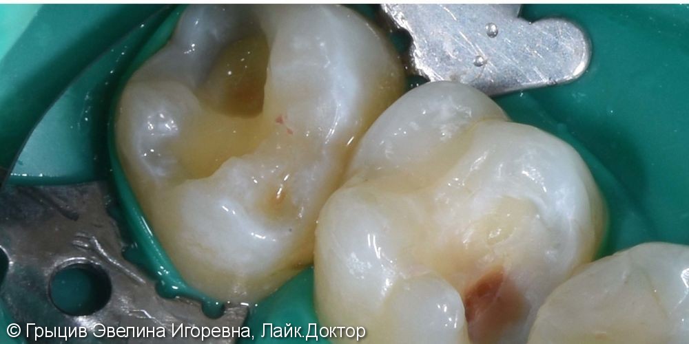 Лечение кариеса 16 и 17 зубов - фото №1