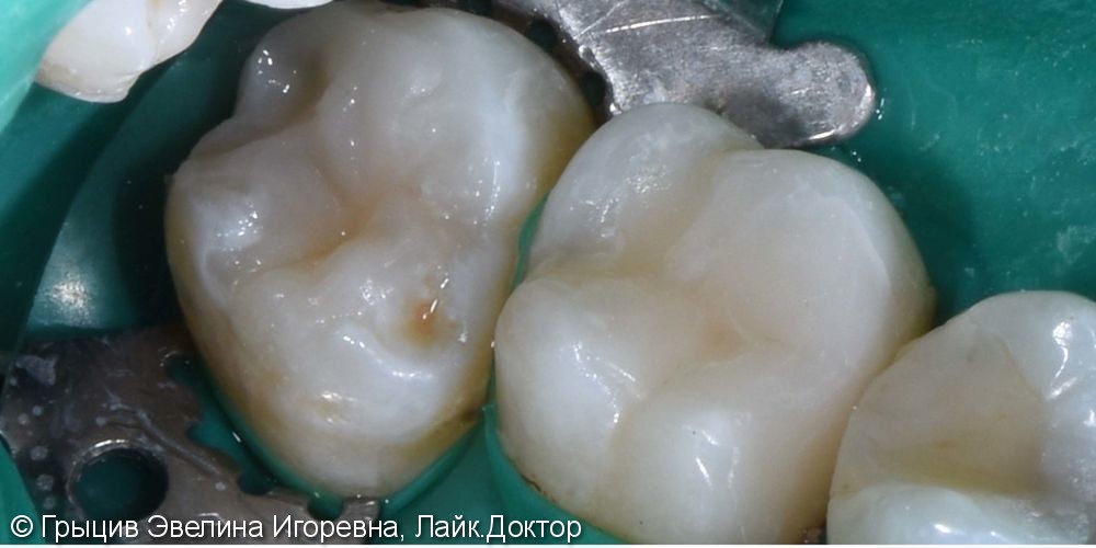 Лечение кариеса 16 и 17 зубов - фото №2