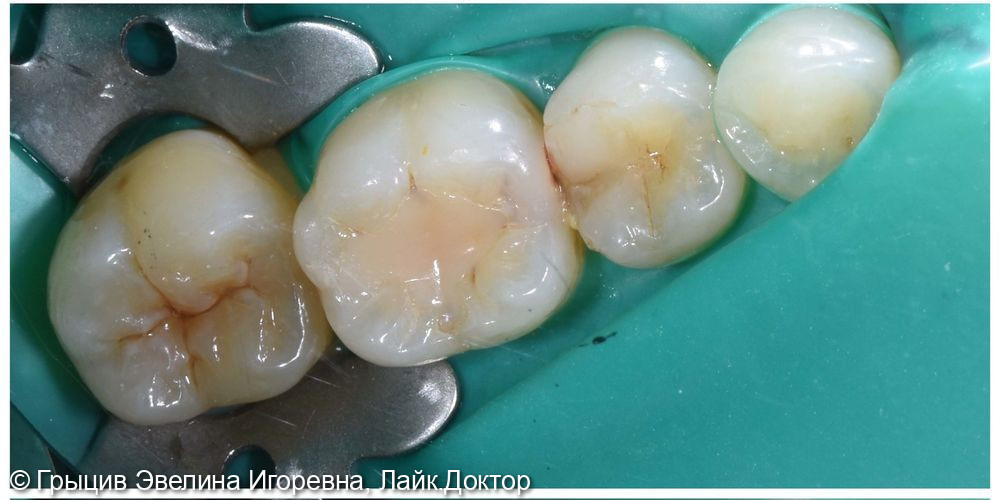 Клинический пример лечения кариеса зубов 47, 46, 45 в одно посещение - фото №1