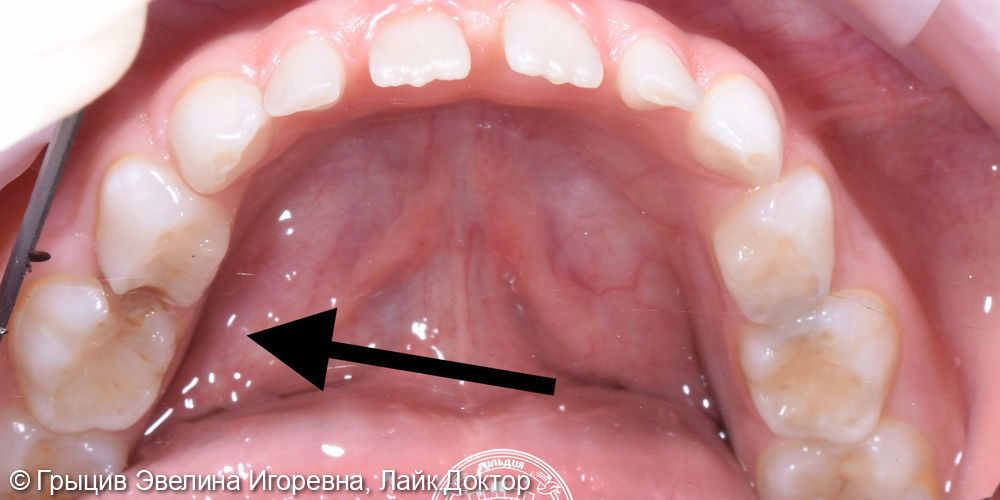 Пример клинического случая лечения молочных зубов - фото №1