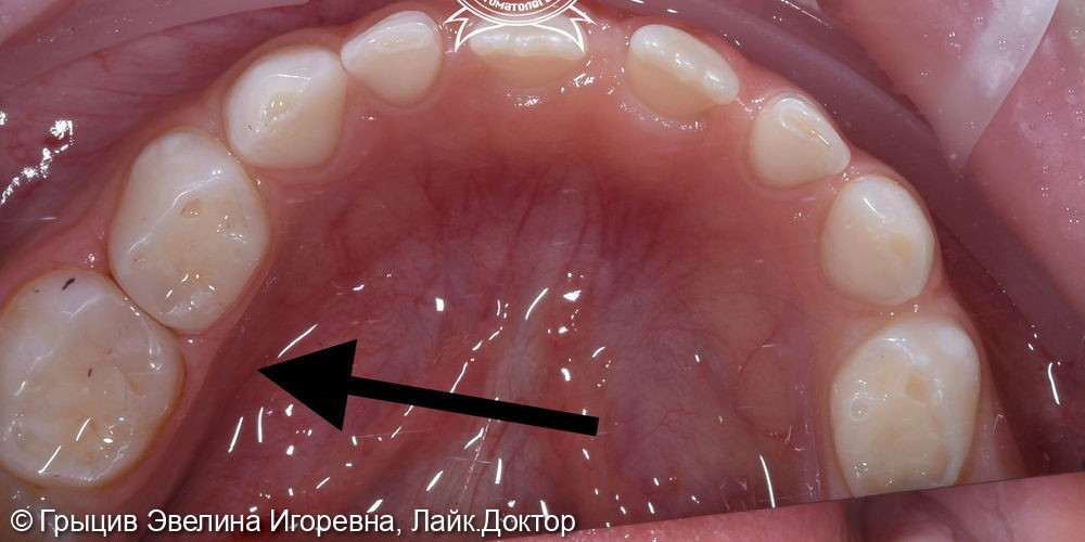 Пример клинического случая лечения молочных зубов - фото №2