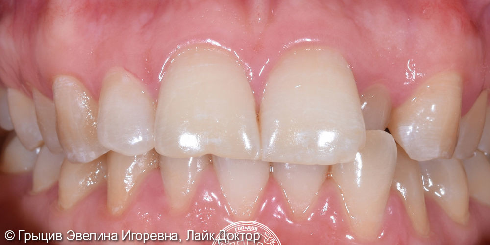Отбеливание зубов системой Beyond Polus - фото №1