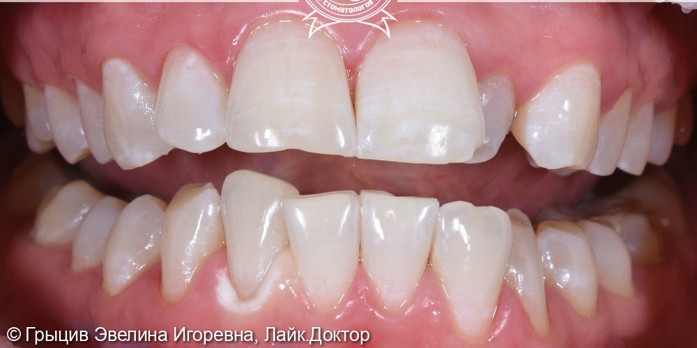 Отбеливание зубов системой Beyond Polus - фото №2