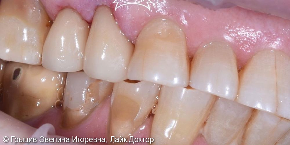 Эстетическая реставрация зубов - фото №2