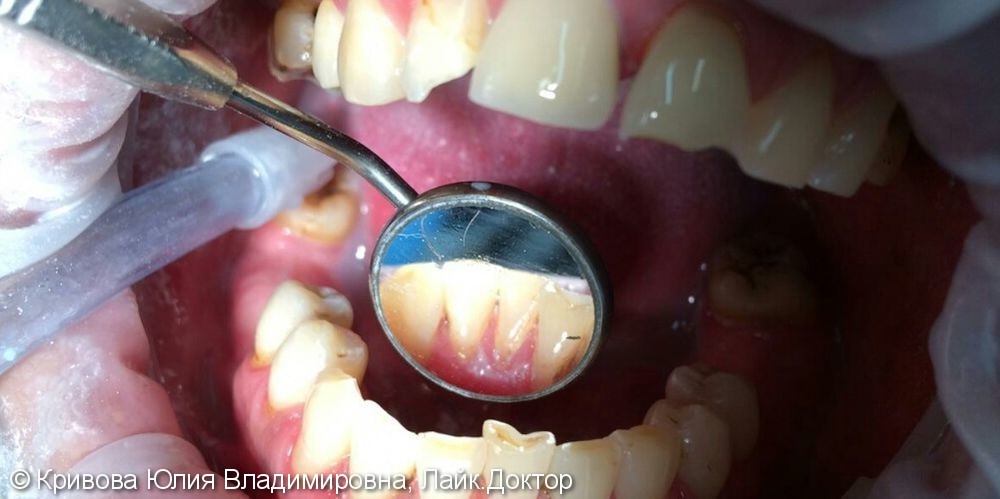 Гигиена зубов и отбеливание - фото №2
