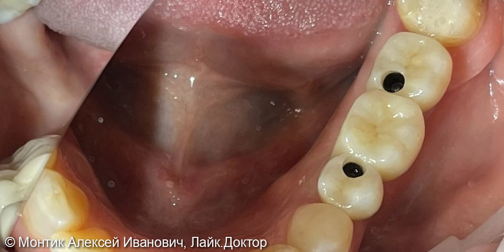 Ималантация системой Osstem + изготовление мостовидного протеза из диоксида циркония - фото №2