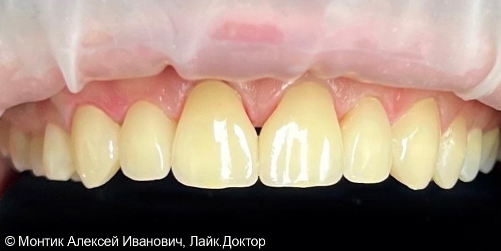 Реставрация фронтальной группы зубов керамическими винирами E.max - фото №1