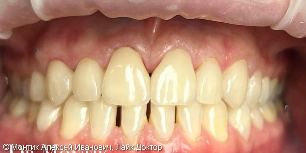 Реставрация фронтальной группы зубов керамическими винирами E.max - фото №2