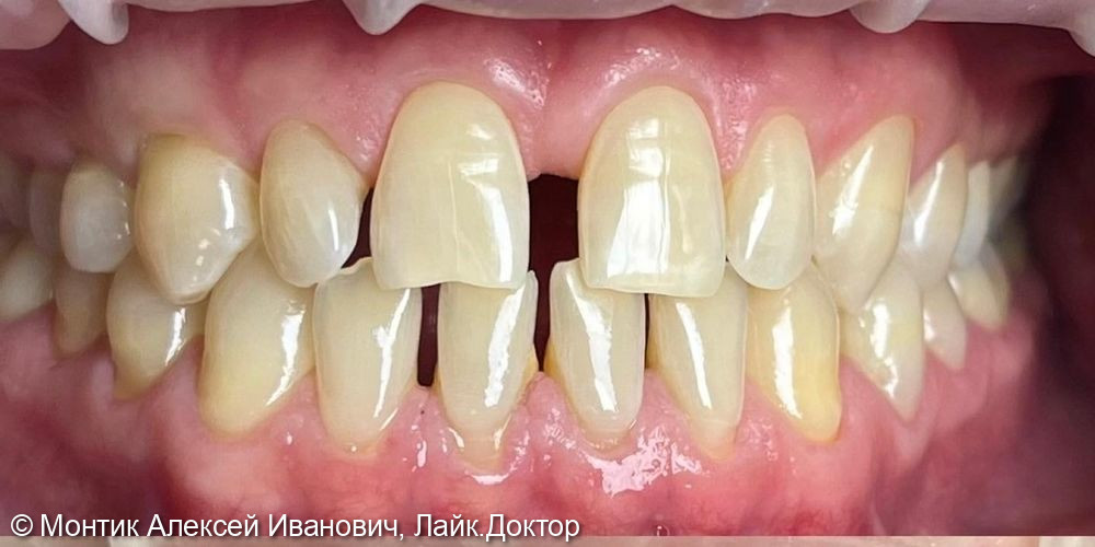Реставрация фронтальной группы зубов керамическими винирами E.max - фото №3