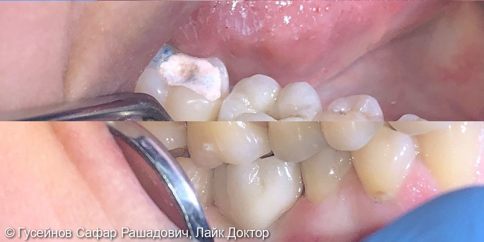Имплантация в области удаленного зуба 4.6 - фото №2