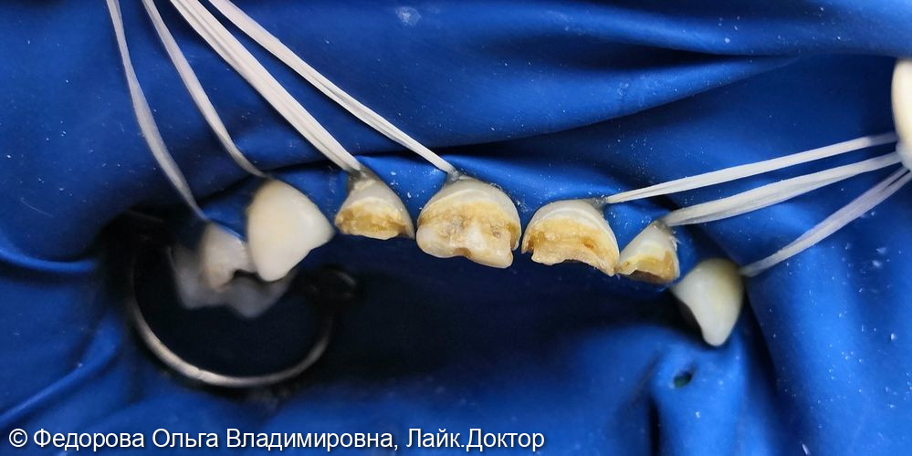 Одномоментное лечение пульпита и восстановление зубов коронками - фото №1