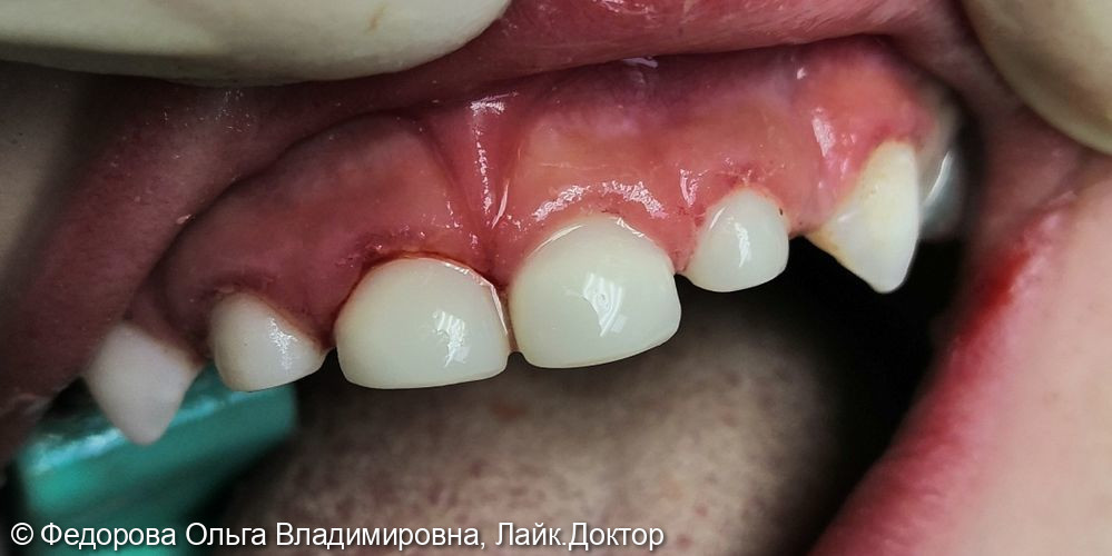 Одномоментное лечение пульпита и восстановление зубов коронками - фото №2