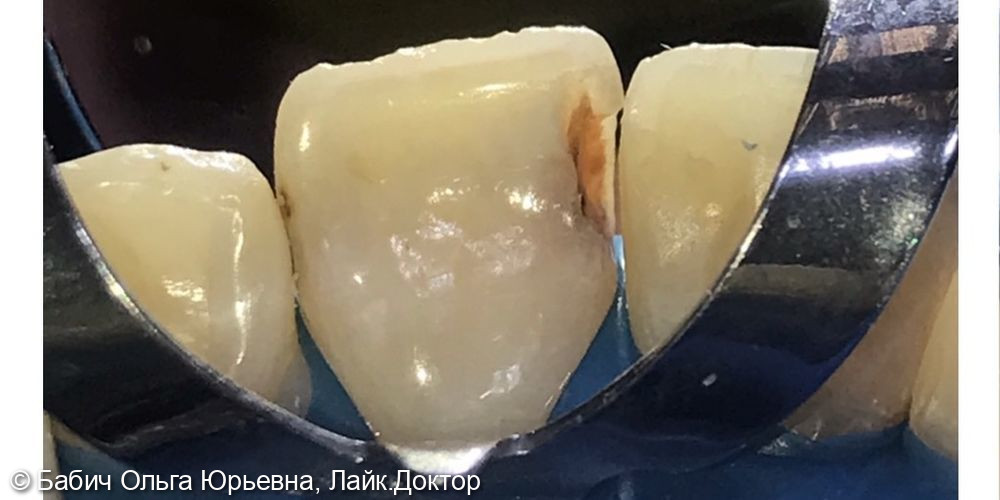 Лечение кариеса дентина зуба 2.1 - фото №1