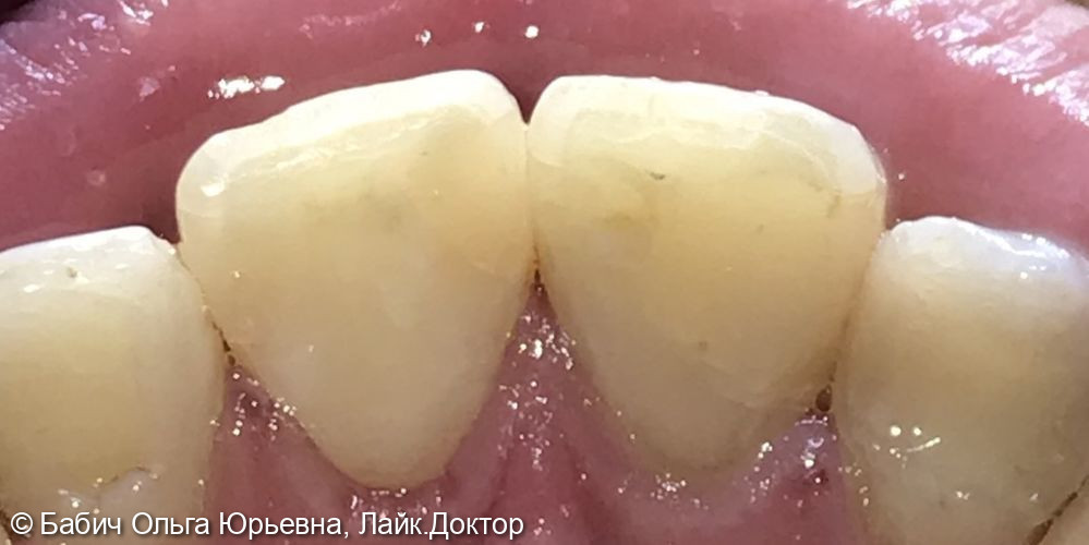 Лечение кариеса дентина зуба 2.1 - фото №3