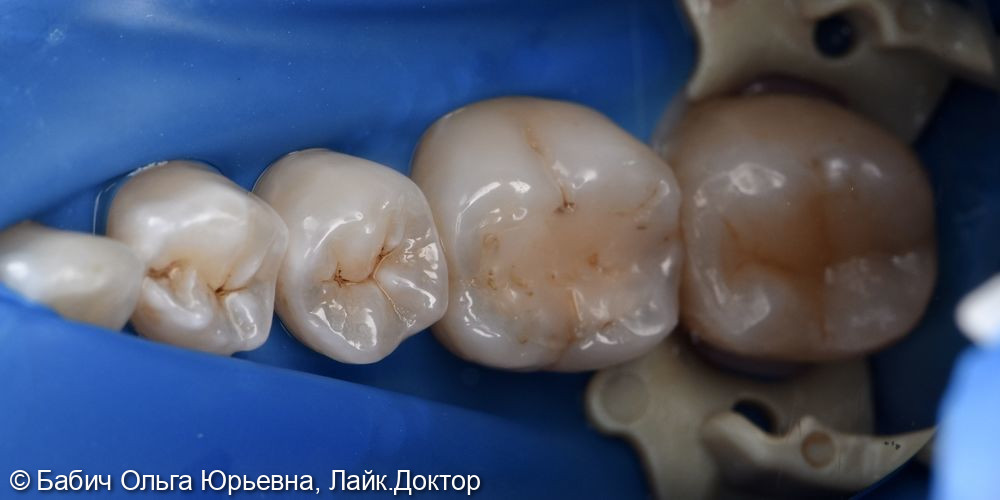 Замена пломбы, лечение кариеса зуба 3.6 - фото №1