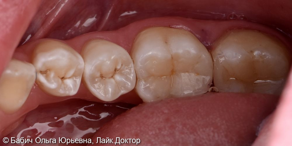 Замена пломбы, лечение кариеса зуба 3.6 - фото №3