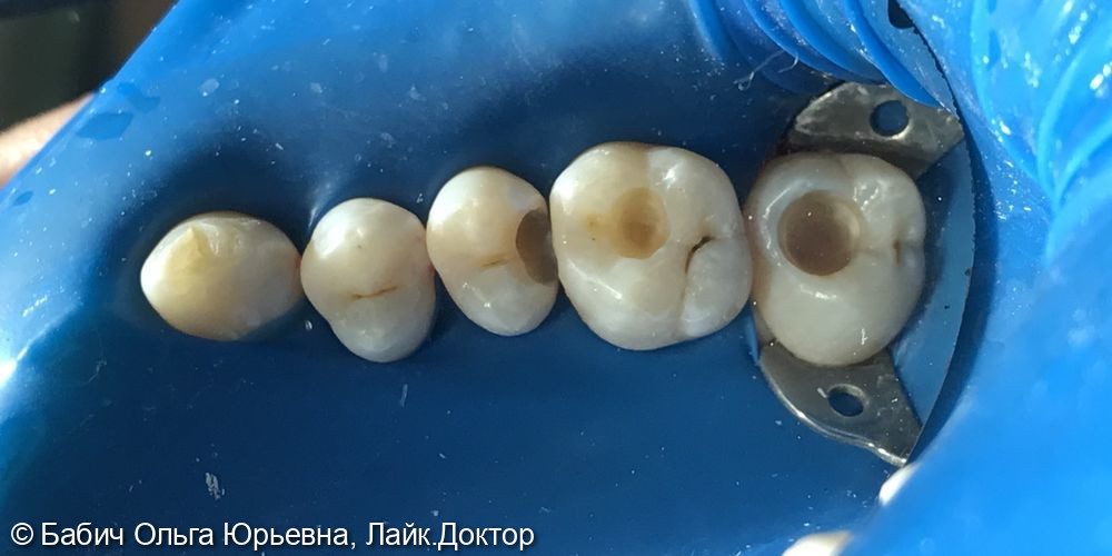 Лечение кариеса зубов 1.5, 1.6, 1.7 фото 2 · Раменское