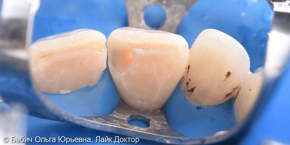 Восстановление зуба 1.1 фото 2 · Раменское