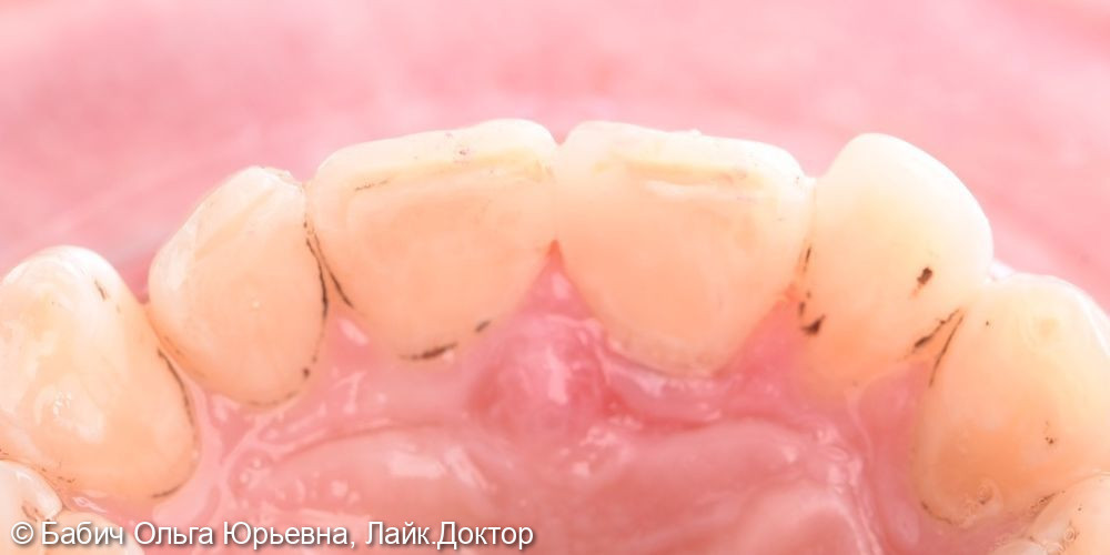 Восстановление зуба 1.1 - фото №3