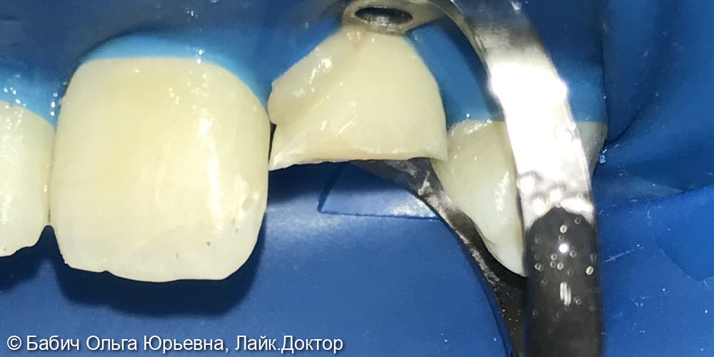 Реставрация зуба 2.2 после травмы - фото №2