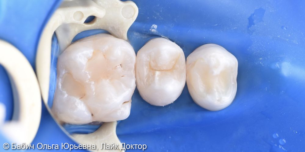 Лечение кариеса зуба 2.5 - фото №2