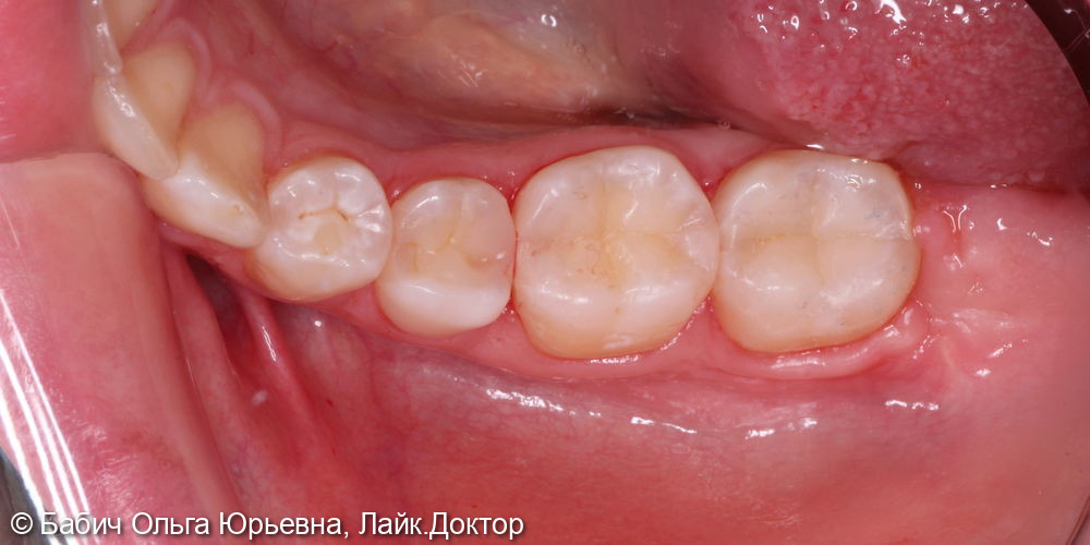 Зубы 4.6 и 4.7 - фото №4