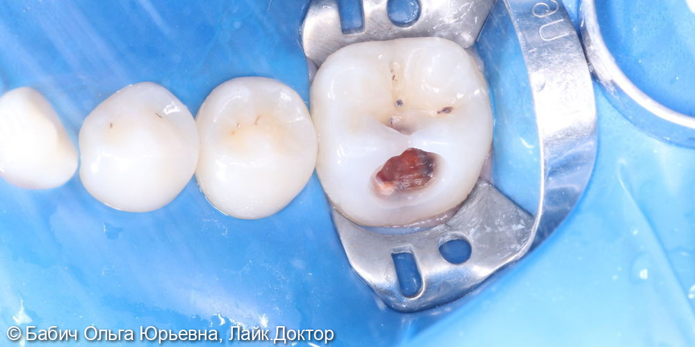 Лечение глубокого кариес зуба 4.6 - фото №2