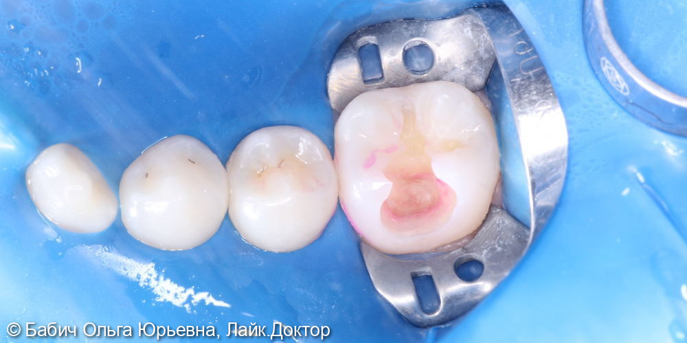Лечение глубокого кариес зуба 4.6 - фото №3